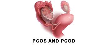 Natural Approaches to Managing PCOS and PCOD with&nbsp;Ayurveda